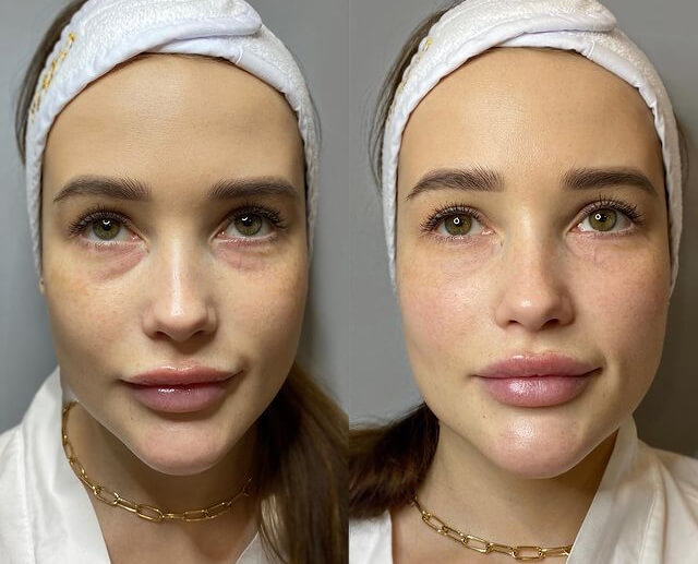 Что делать с нежной кожей век - СМИ о клинике Skin Art